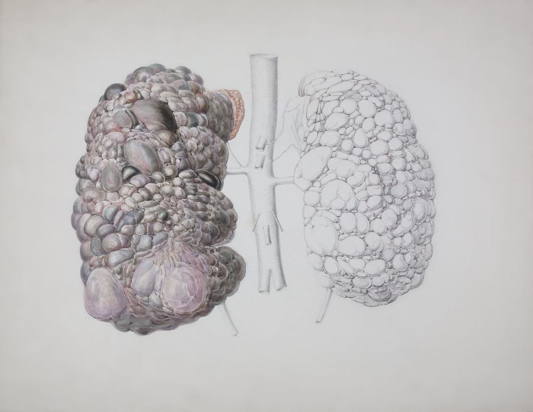 Photo Kidney Damage